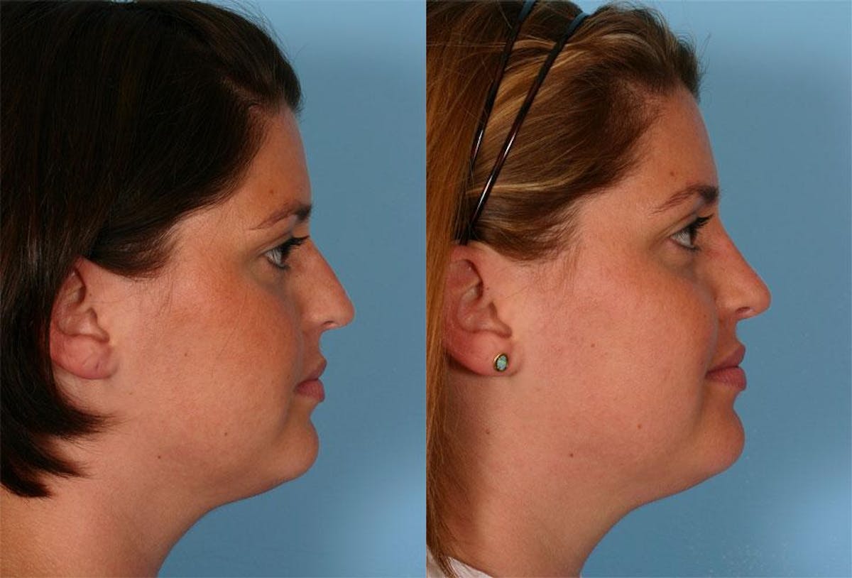 Nasal Obstruction Before & After Gallery - Patient 152009 - Image 2