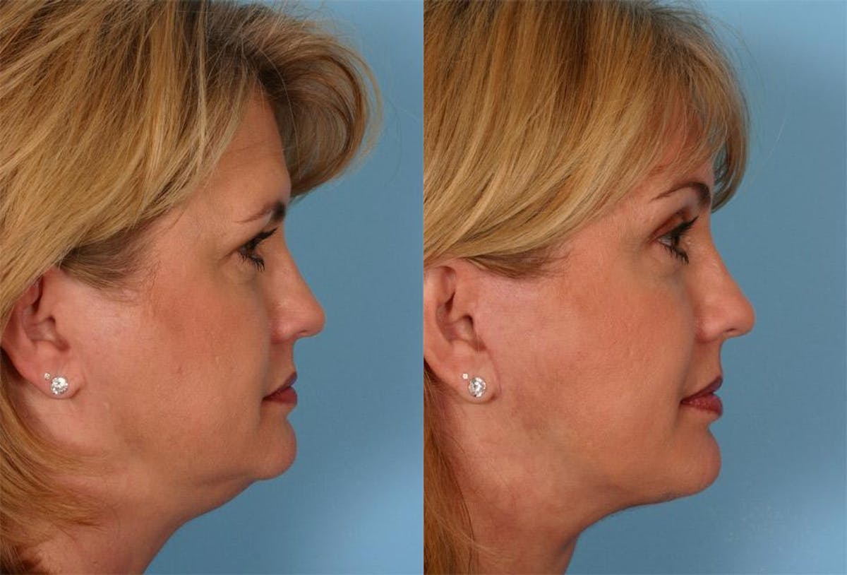 Endoscoplic Browlift Before & After Gallery - Patient 290149 - Image 3