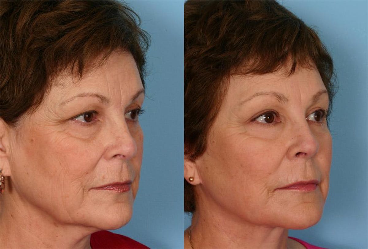 Facial Fat Transfer Before & After Gallery - Patient 308493 - Image 2