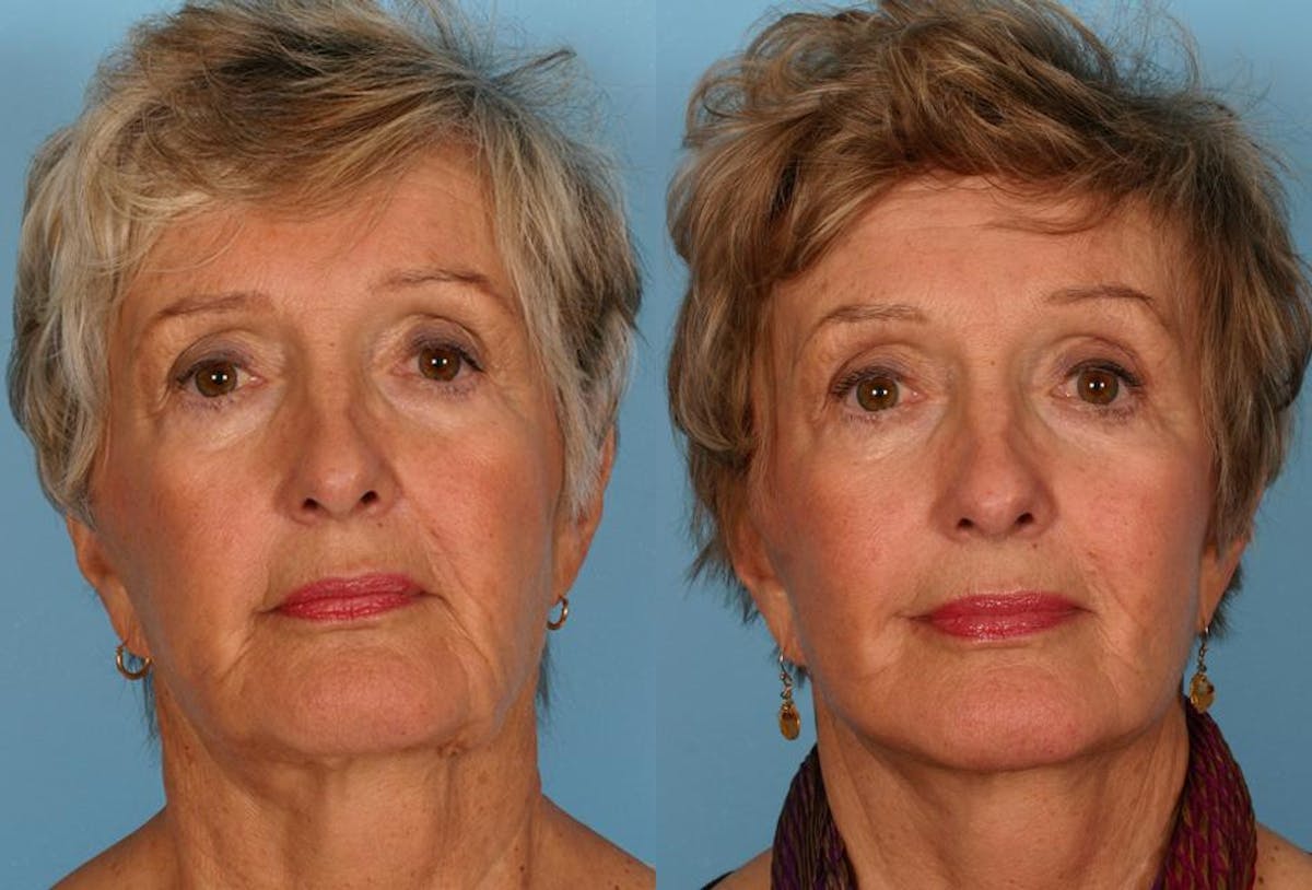 Limited Incision Facelift Before & After Gallery - Patient 143127 - Image 1