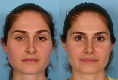 Revision Rhinoplasty Before & After Gallery - Patient 213999 - Image 1