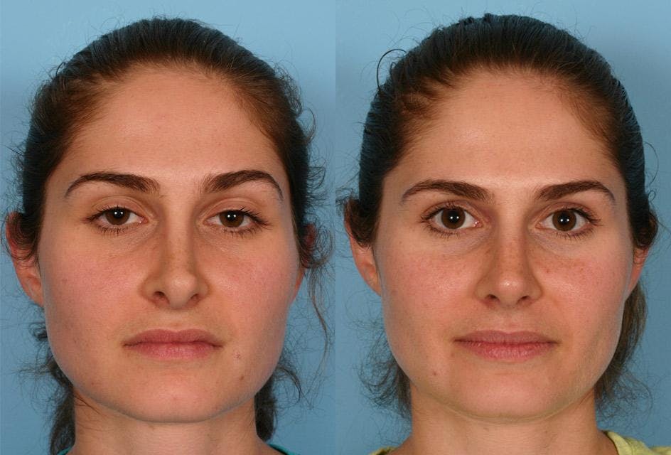 Revision Rhinoplasty Before & After Gallery - Patient 213999 - Image 1