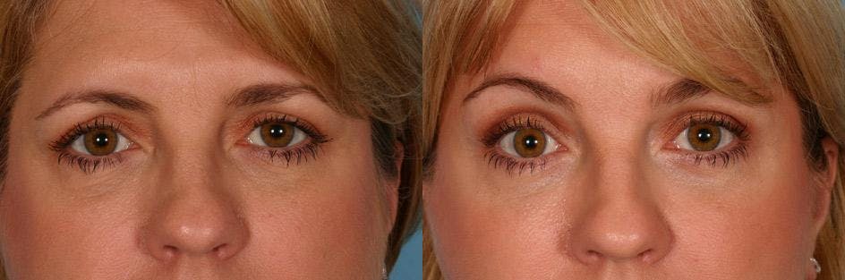 Endoscopic Brow Lift Before & After Gallery - Patient 290149 - Image 4