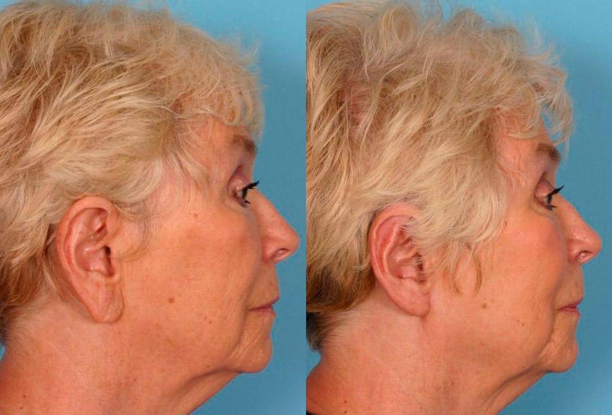 Ear Surgery (Otoplasty) Before & After Gallery - Patient 374305 - Image 3