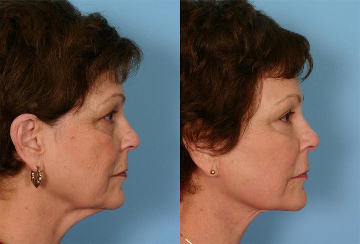 Facial Fat Transfer Before & After Gallery - Patient 308493 - Image 3