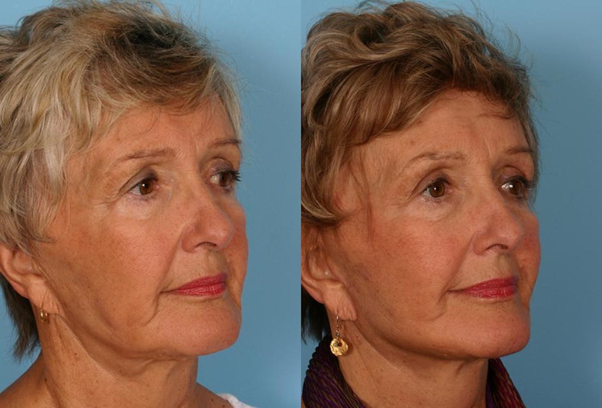 Limited Incision Facelift Before & After Gallery - Patient 143127 - Image 2