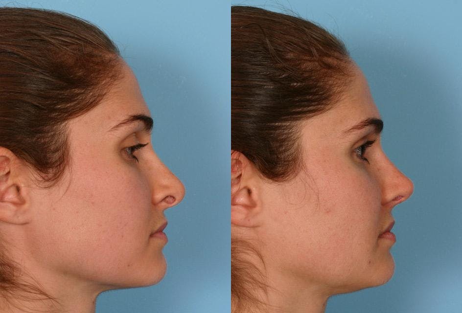 Revision Rhinoplasty Before & After Gallery - Patient 213999 - Image 2