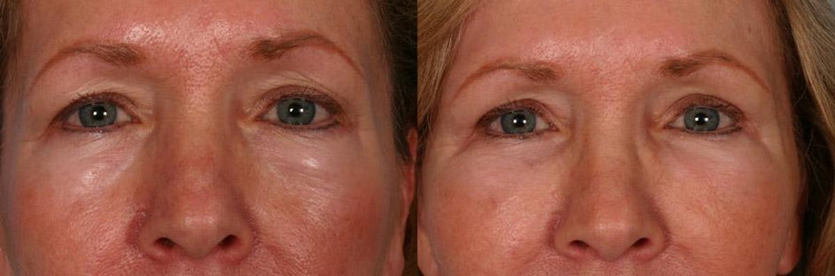 Eyelid Surgery (Blepharoplasty) Before & After Gallery - Patient 387661 - Image 4