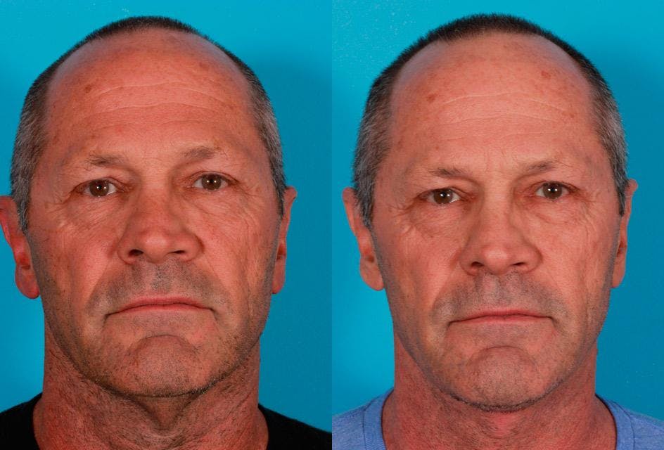 Neck Lift Before & After Gallery - Patient 683497 - Image 1