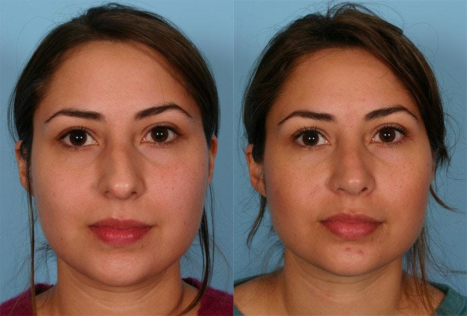 Rhinoplasty Before & After Gallery - Patient 206176 - Image 2