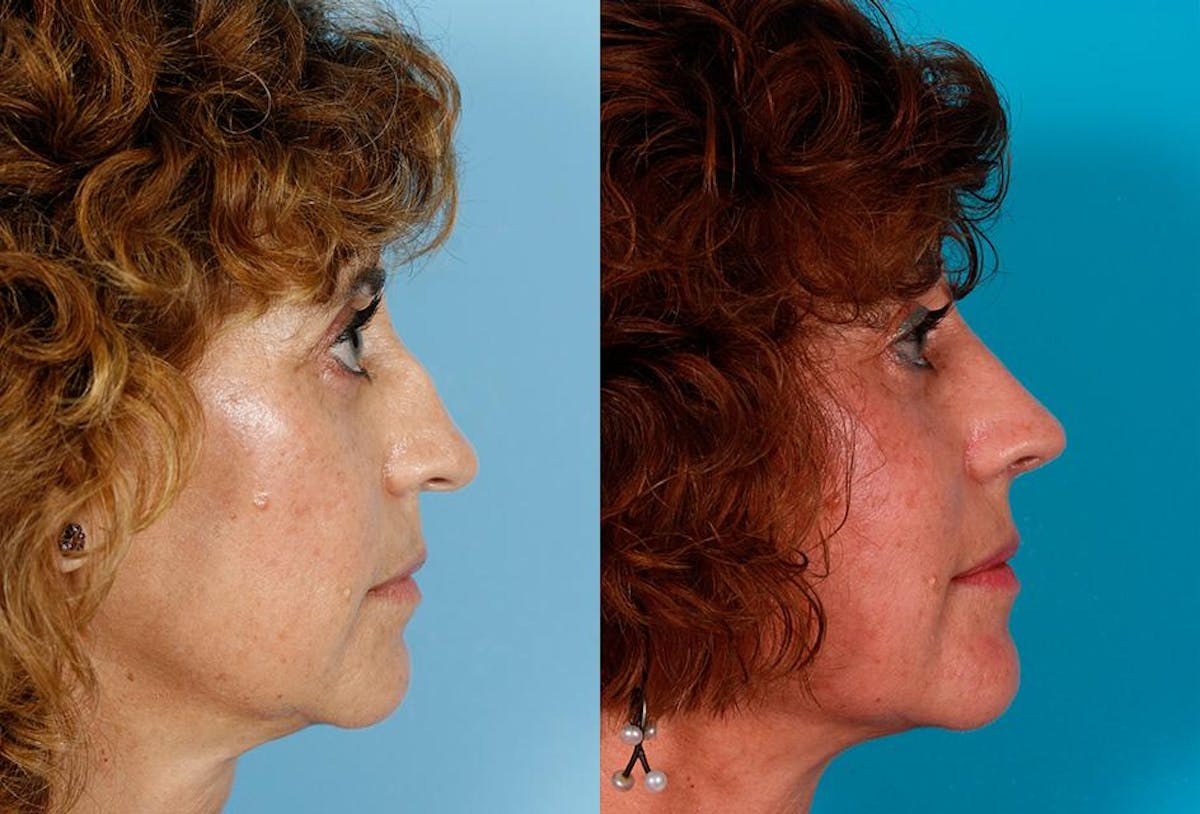 Nasal Obstruction Before & After Gallery - Patient 332535 - Image 2