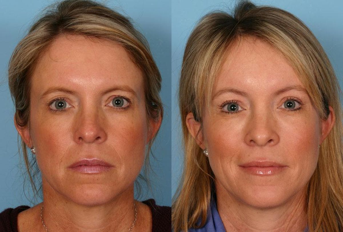 Endoscoplic Browlift Before & After Gallery - Patient 380900 - Image 1