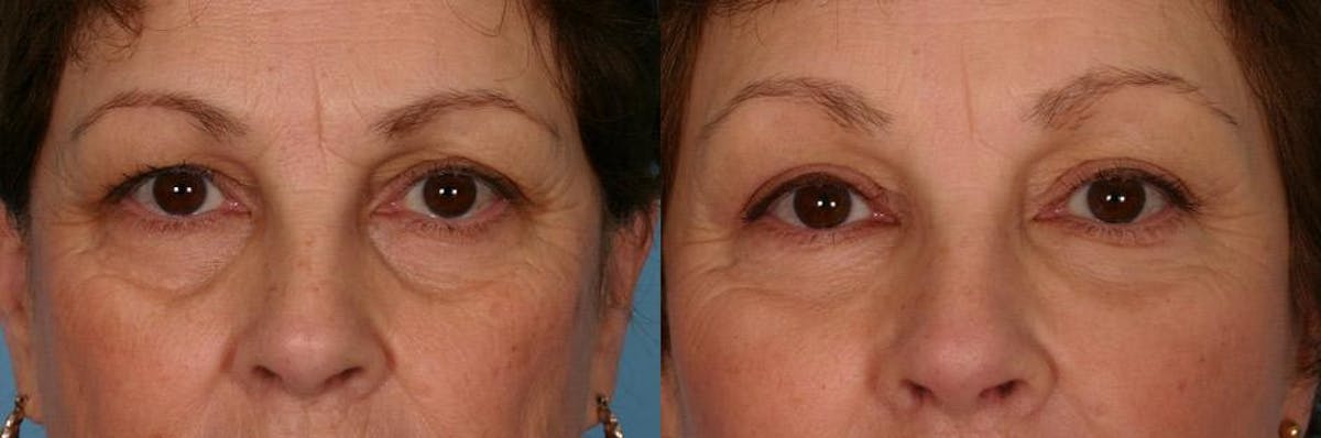 Facial Fat Transfer Before & After Gallery - Patient 308493 - Image 4