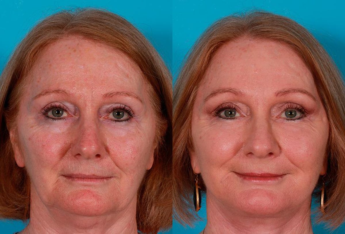 Facelift Before & After Gallery - Patient 181414 - Image 1