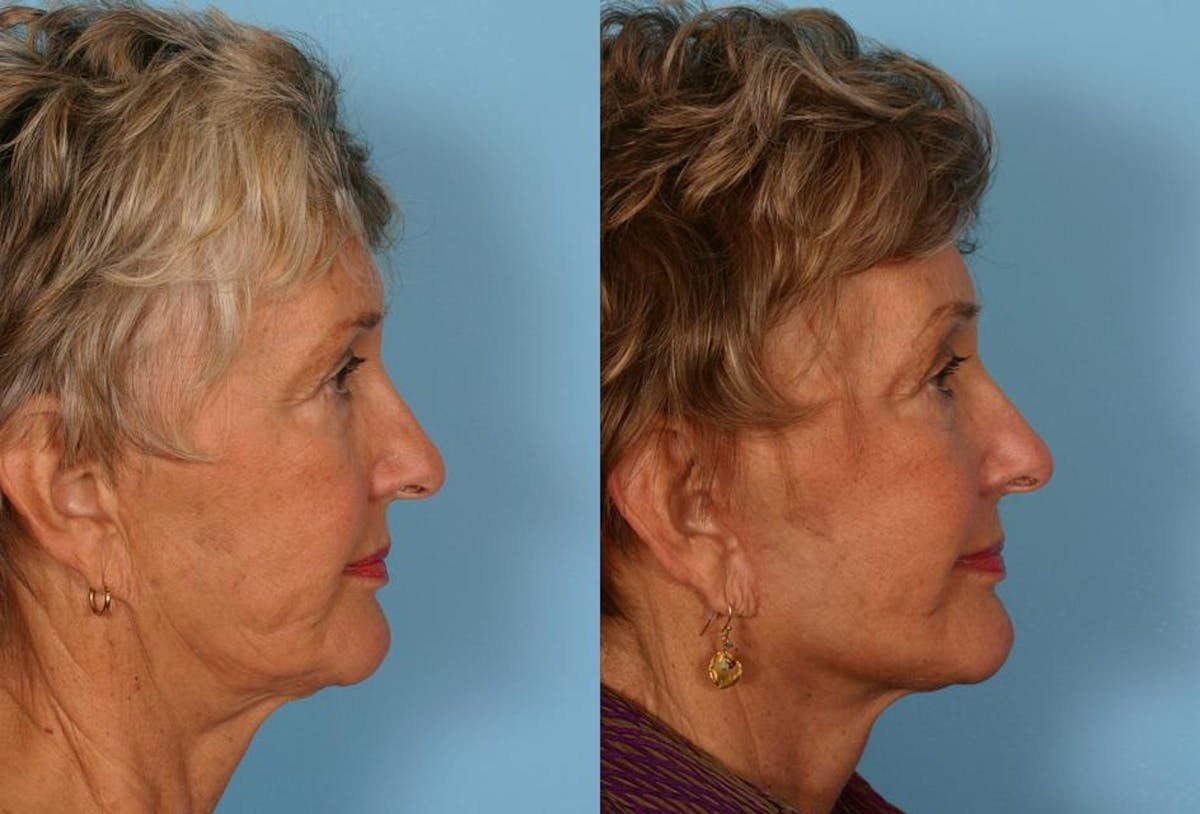 Limited Incision Facelift Before & After Gallery - Patient 143127 - Image 3