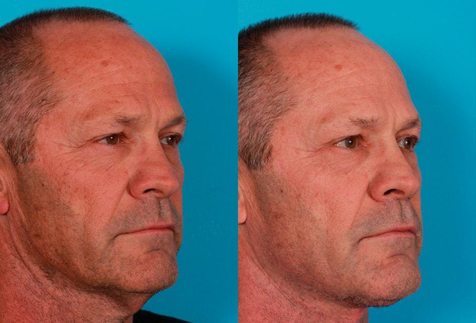 Neck Lift Before & After Gallery - Patient 683497 - Image 2