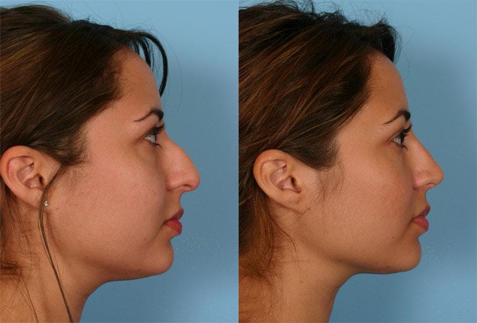 Rhinoplasty Before & After Gallery - Patient 206176 - Image 1