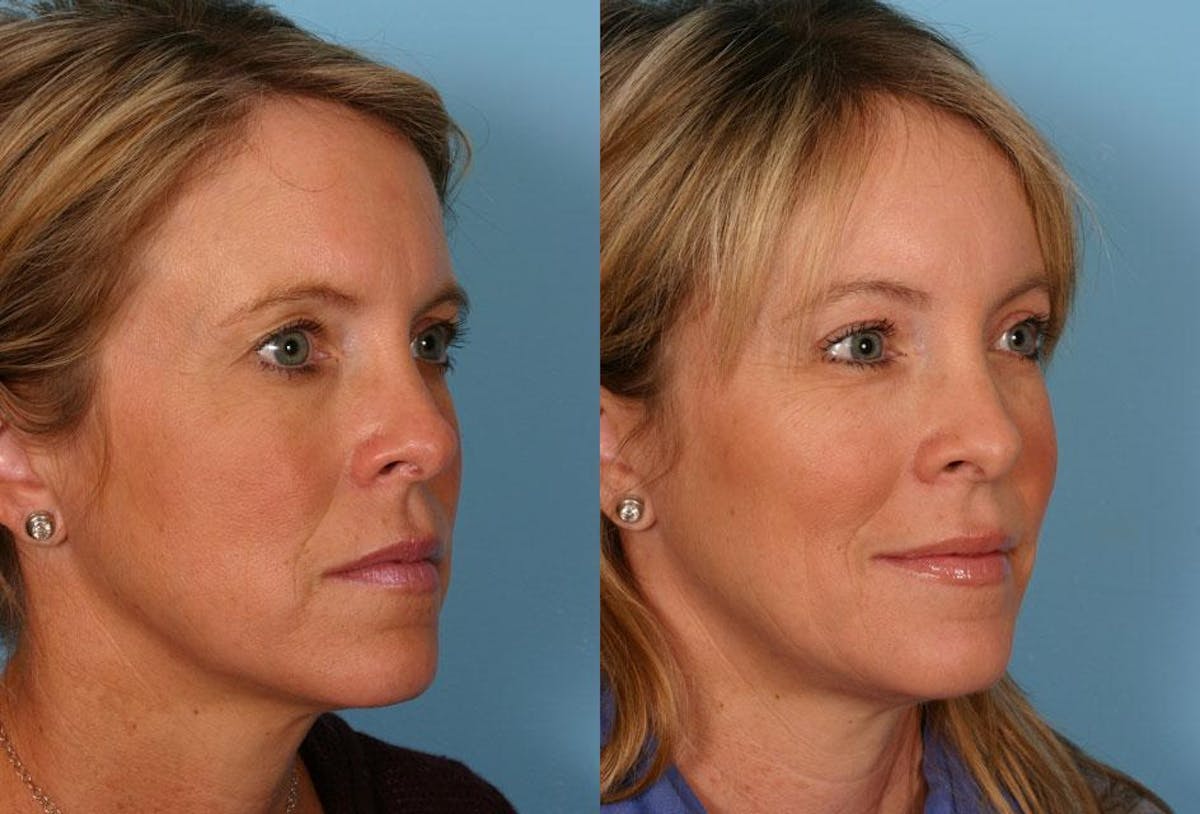 Endoscoplic Browlift Before & After Gallery - Patient 380900 - Image 2