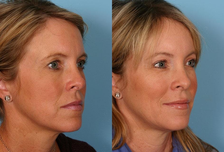 Endoscopic Brow Lift Before & After Gallery - Patient 380900 - Image 2