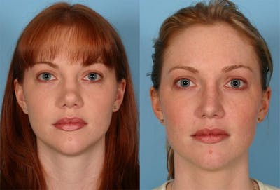 Revision Rhinoplasty Before & After Gallery - Patient 278776 - Image 1