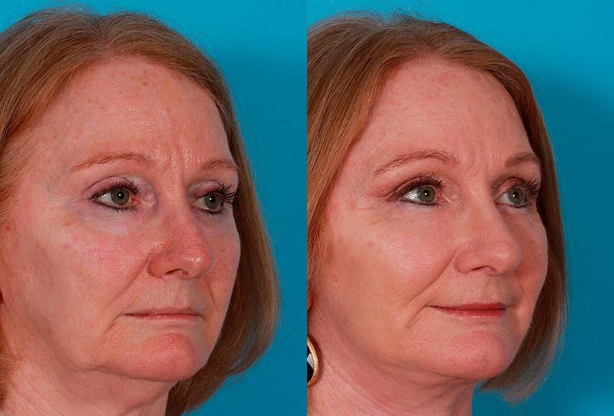 Facelift Before & After Gallery - Patient 181414 - Image 2