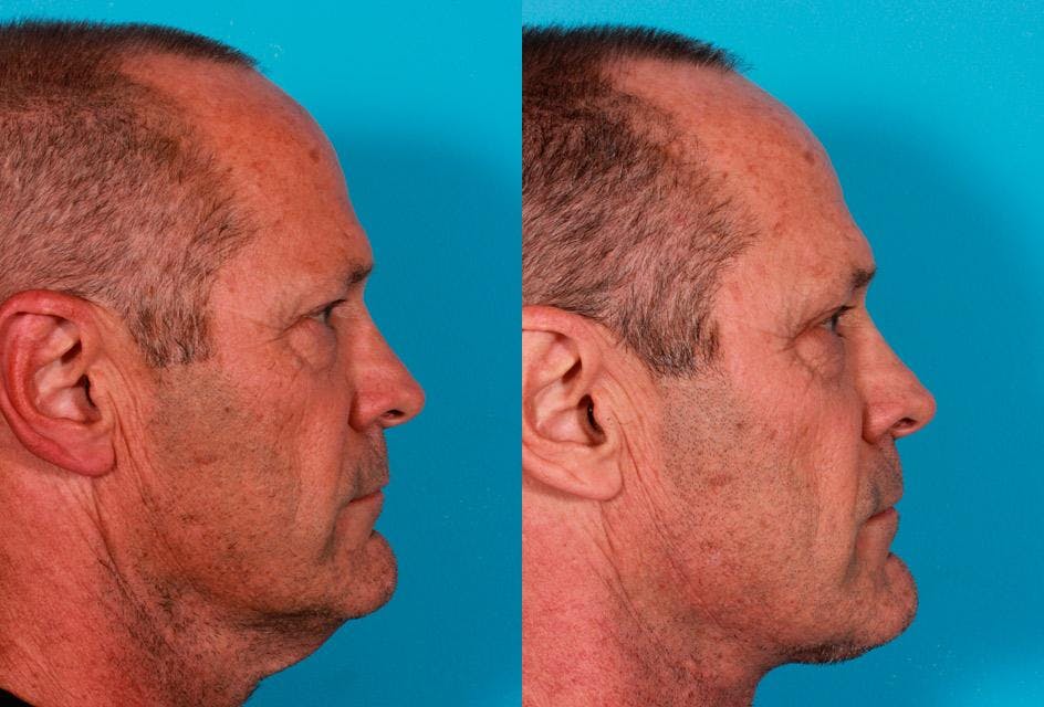 Neck Lift Before & After Gallery - Patient 683497 - Image 3