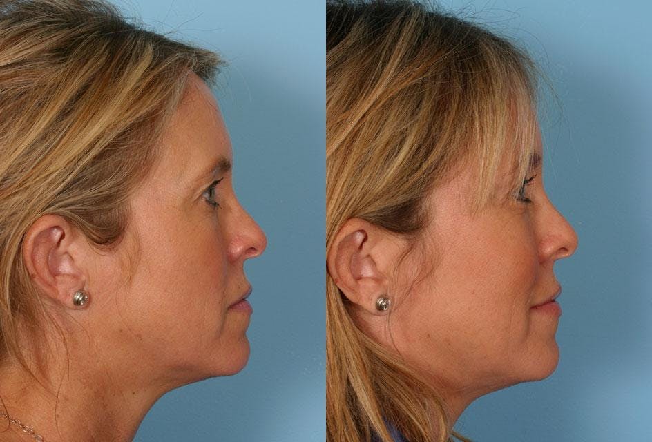 Endoscopic Brow Lift Before & After Gallery - Patient 380900 - Image 3