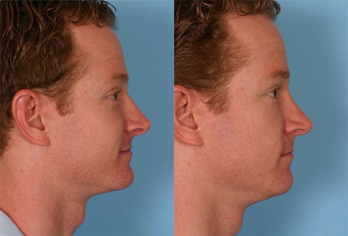 Nasal Obstruction Before & After Gallery - Patient 427421 - Image 2