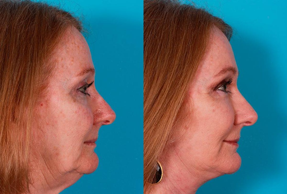 Facelift Before & After Gallery - Patient 181414 - Image 3