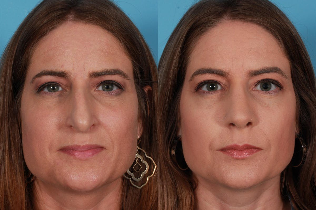 Rhinoplasty Before & After Gallery - Patient 385470 - Image 1