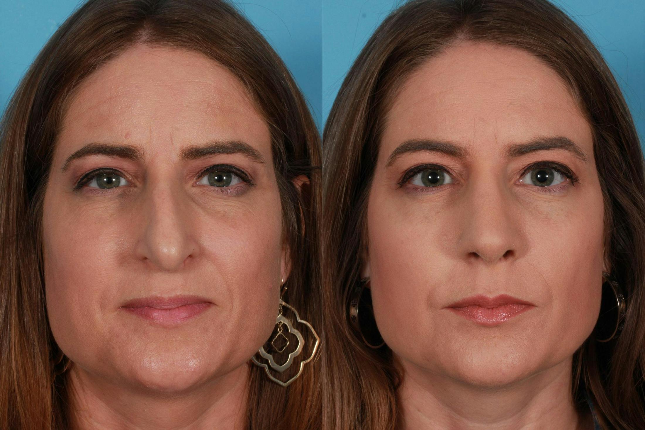 Rhinoplasty Before & After Gallery - Patient 385470 - Image 2
