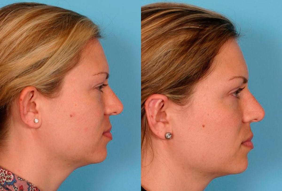 Ear Surgery (Otoplasty) Before & After Gallery - Patient 425990 - Image 3
