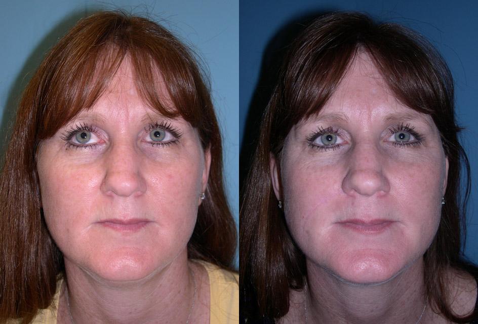 Patient 225341 | Skin Cancer Before & After Photos | Buckingham