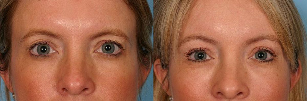 Endoscoplic Browlift Before & After Gallery - Patient 380900 - Image 4