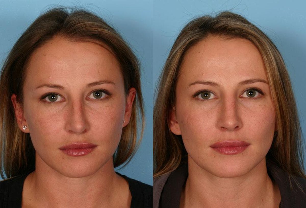 Revision Rhinoplasty Before & After Gallery - Patient 339282 - Image 1