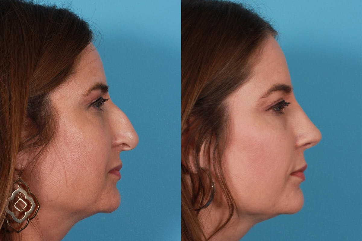 Rhinoplasty Before & After Gallery - Patient 385470 - Image 2