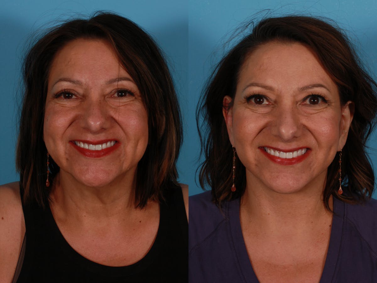 Facelift Before & After Gallery - Patient 300494 - Image 1