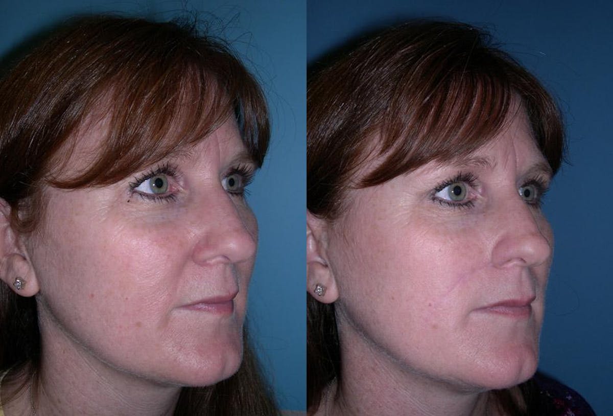 Skin Cancer Before & After Gallery - Patient 225341 - Image 2