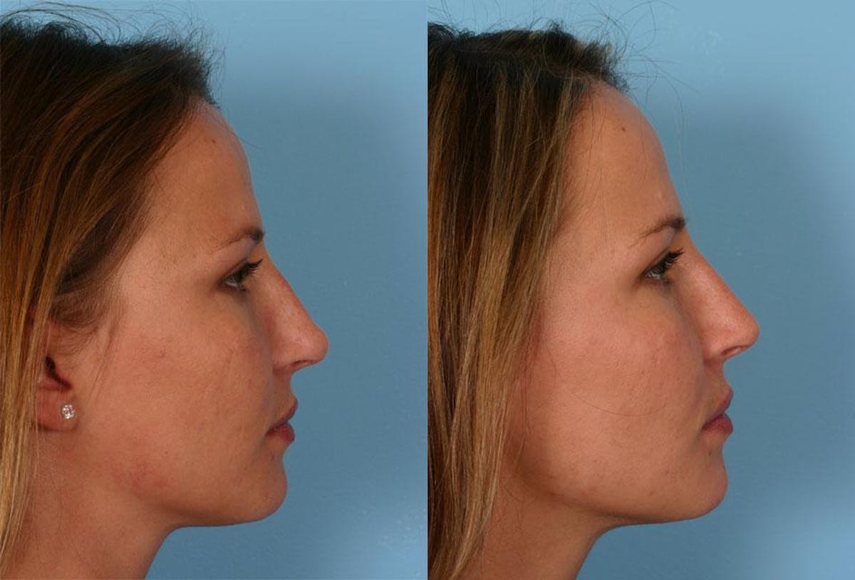 Revision Rhinoplasty Before & After Gallery - Patient 339282 - Image 2
