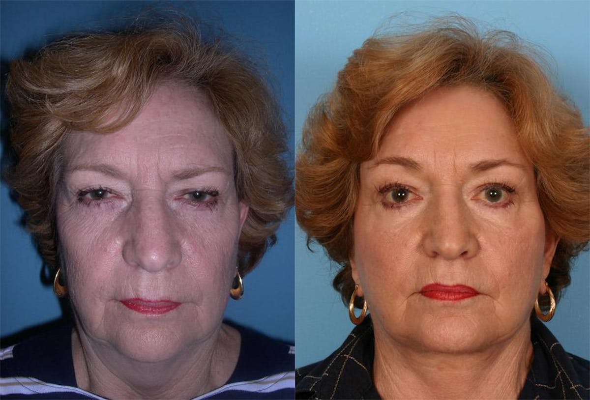 Endoscoplic Browlift Before & After Gallery - Patient 113213 - Image 1