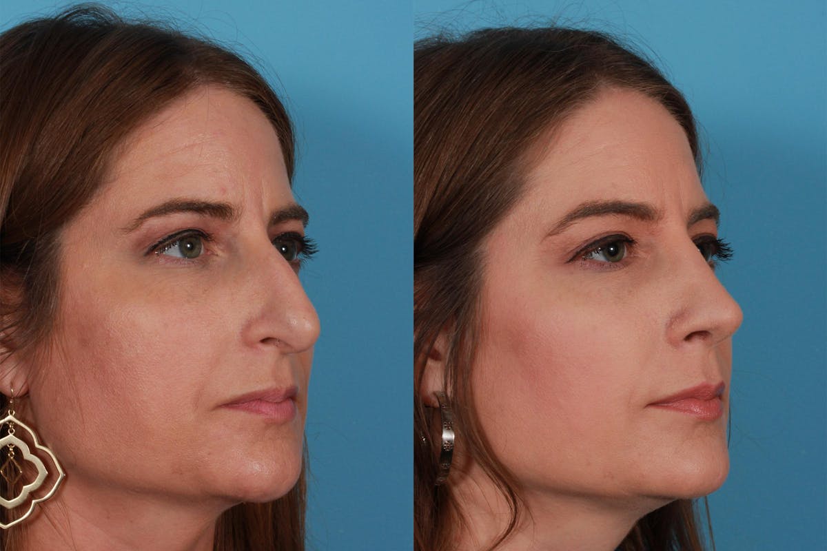 Rhinoplasty Before & After Gallery - Patient 385470 - Image 3