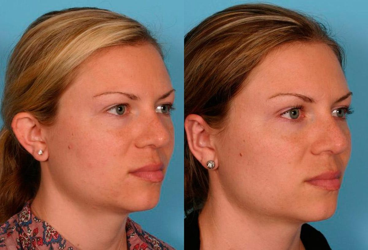 Ear Surgery (Otoplasty) Before & After Gallery - Patient 425990 - Image 5