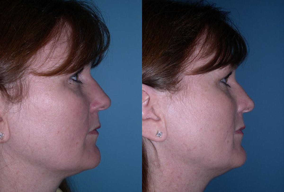 Skin Cancer Before & After Gallery - Patient 225341 - Image 3