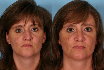 Nasal Obstruction Before & After Gallery - Patient 380930 - Image 1