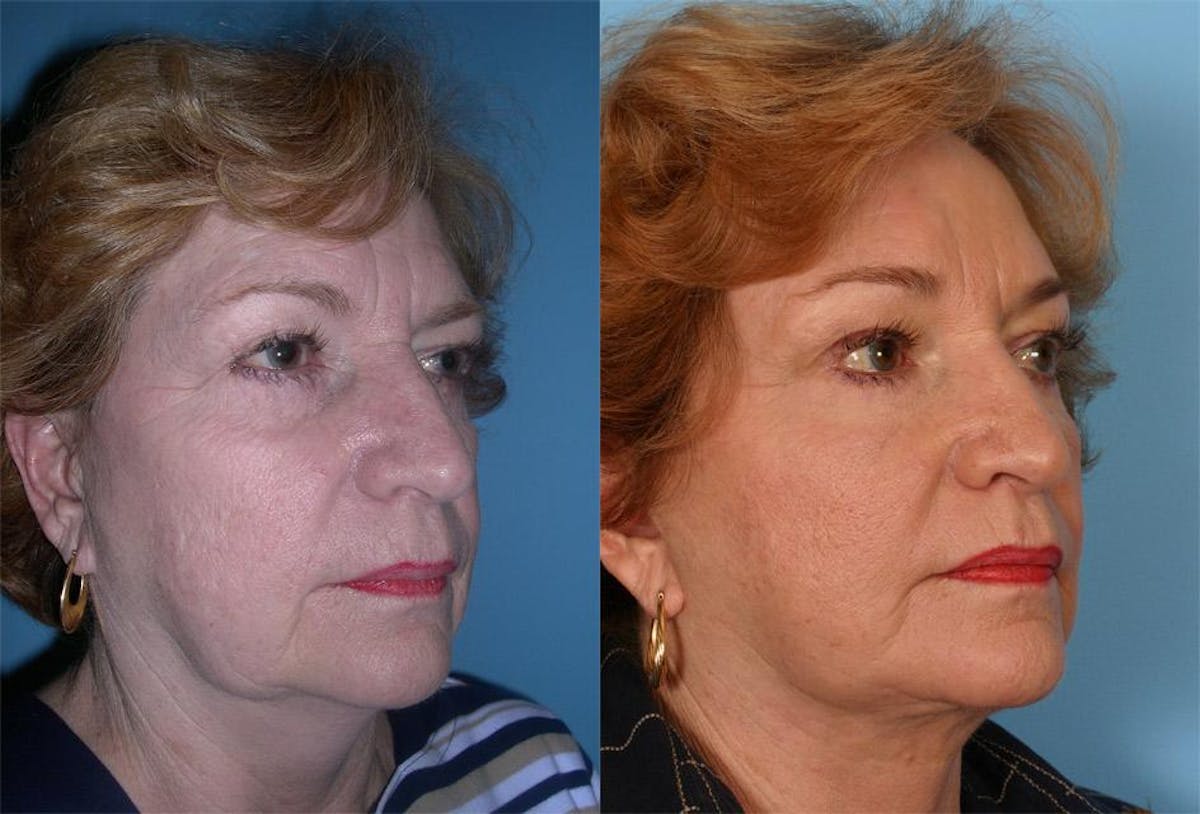 Endoscoplic Browlift Before & After Gallery - Patient 113213 - Image 2