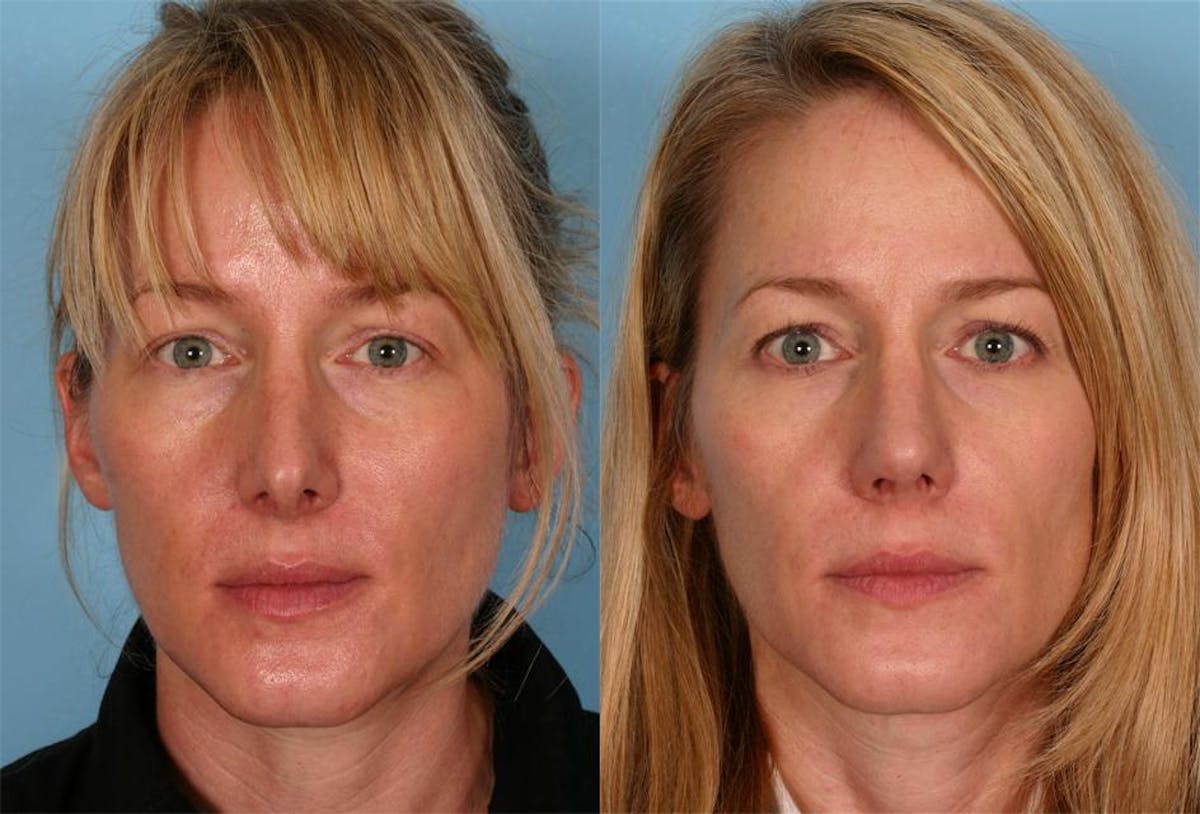 Revision Rhinoplasty Before & After Gallery - Patient 237272 - Image 1