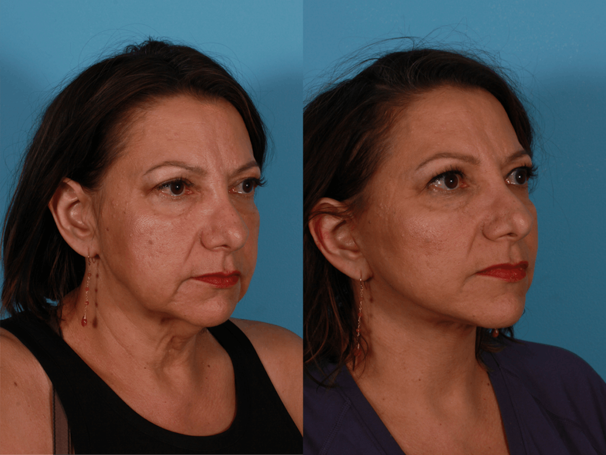 Facelift Before & After Gallery - Patient 300494 - Image 2