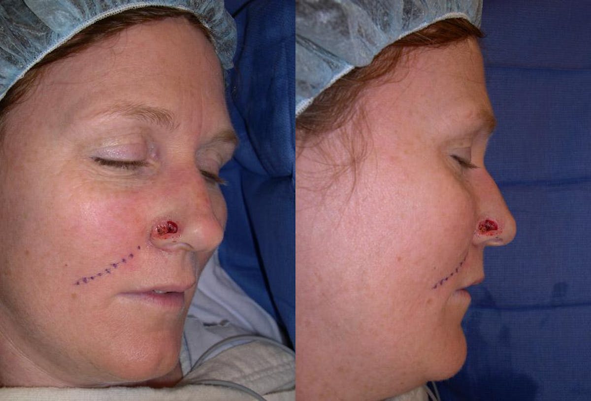 Skin Cancer Before & After Gallery - Patient 225341 - Image 4