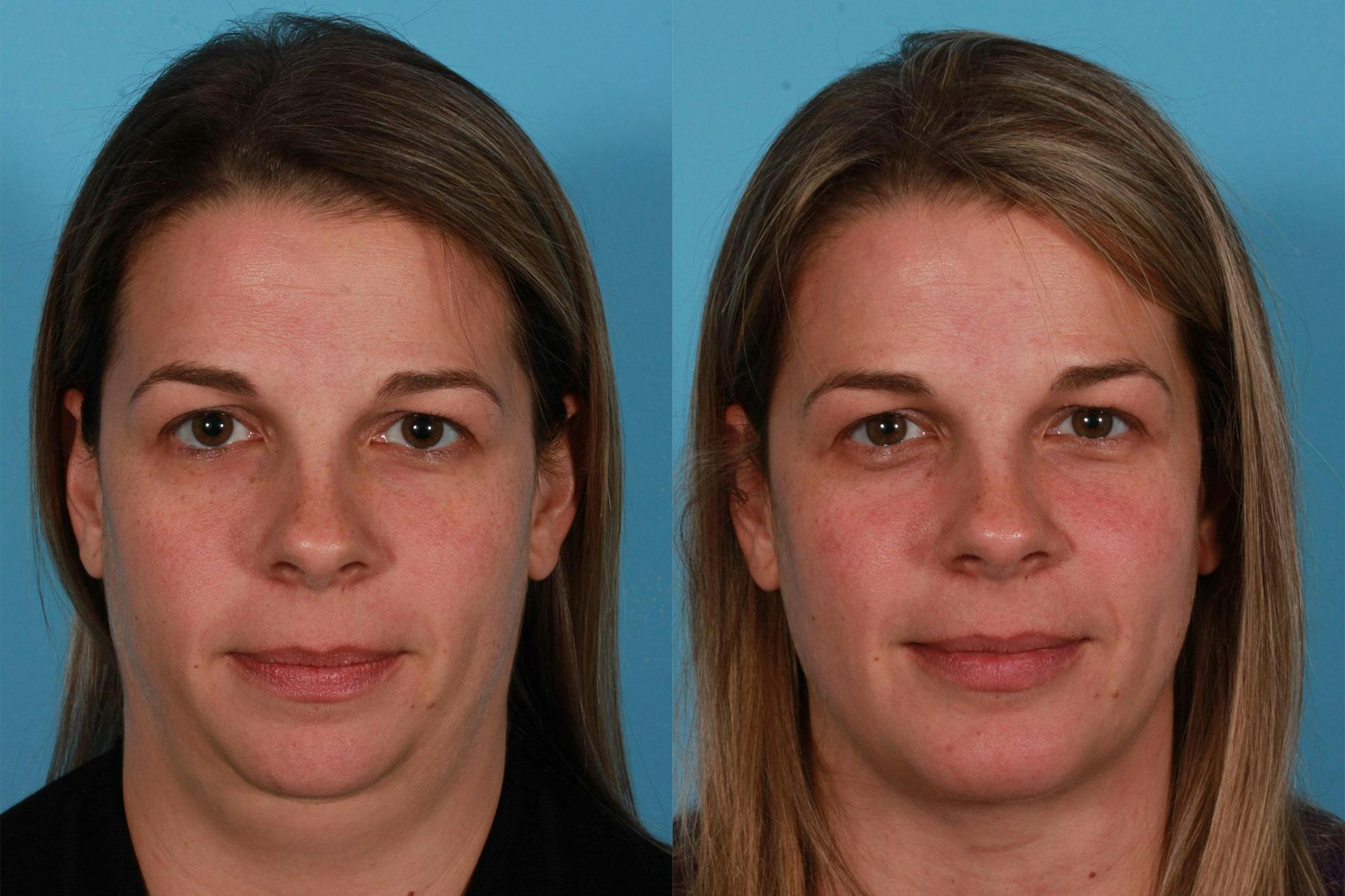 Neck Lift Before & After Gallery - Patient 310996 - Image 1