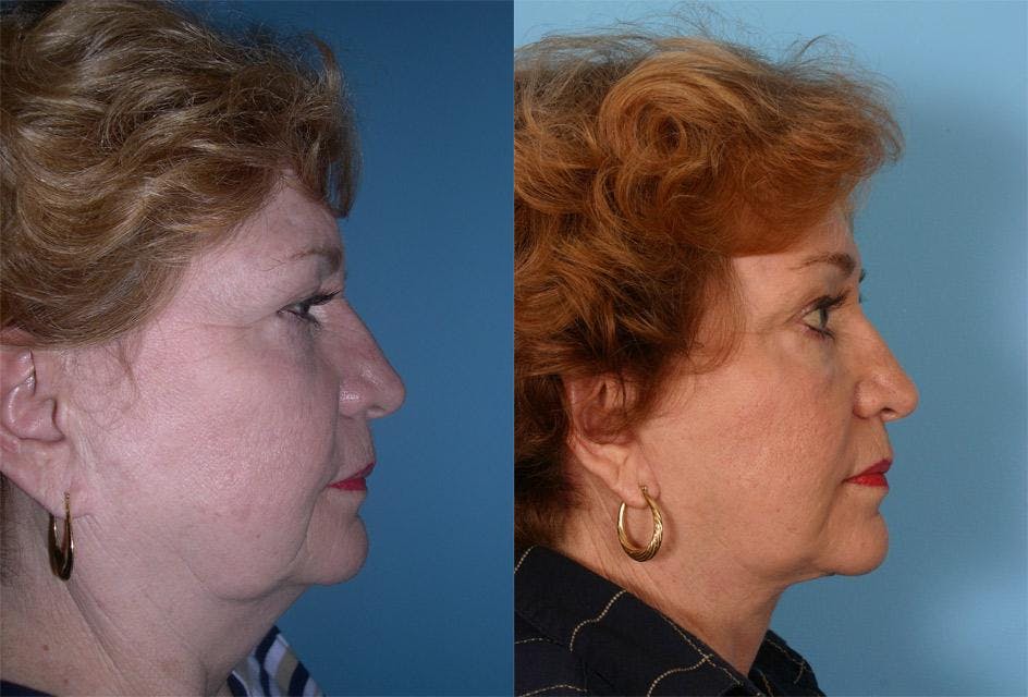 Endoscopic Brow Lift Before & After Gallery - Patient 113213 - Image 3
